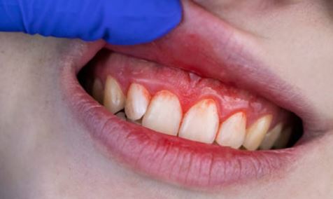 ब्रश करते समय कहीं आपके दांतों से भी तो नहीं आ रहा खून, खतरनाक बीमारी के हैं लक्षण